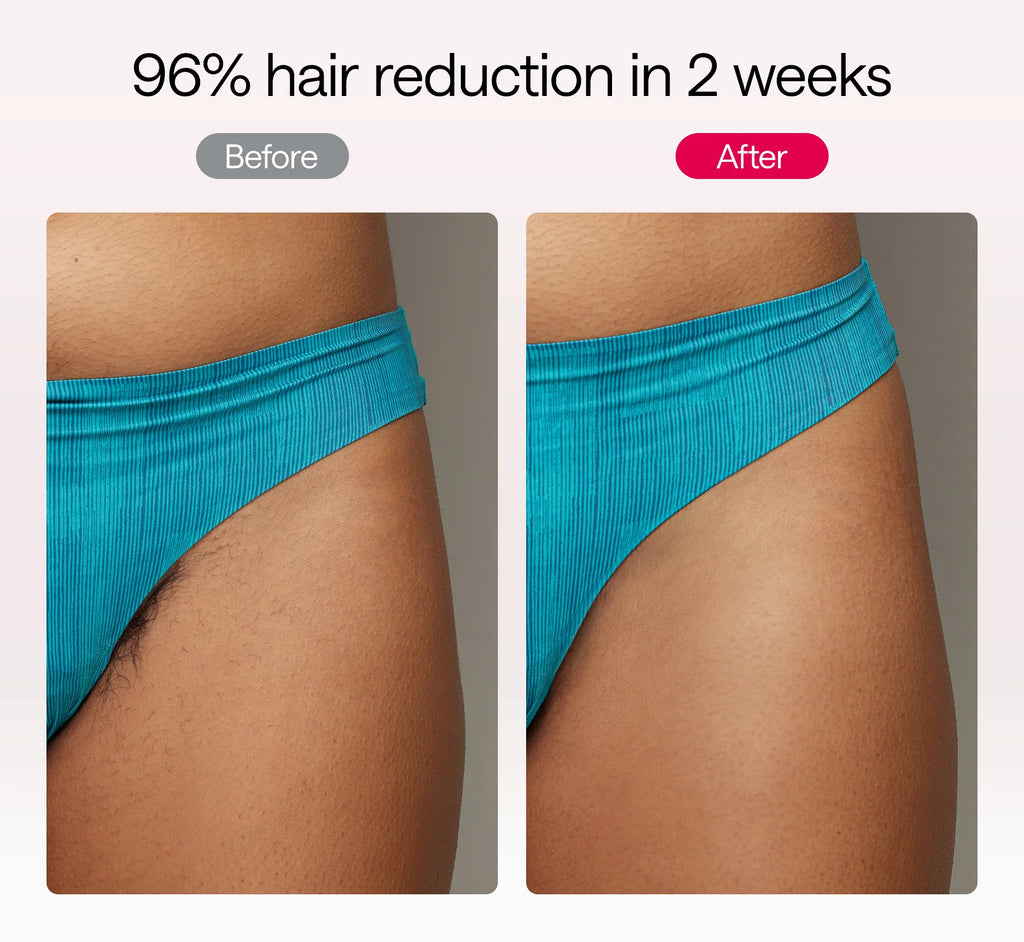 2025 Ulike Air 10 IPL Hair Removal Device